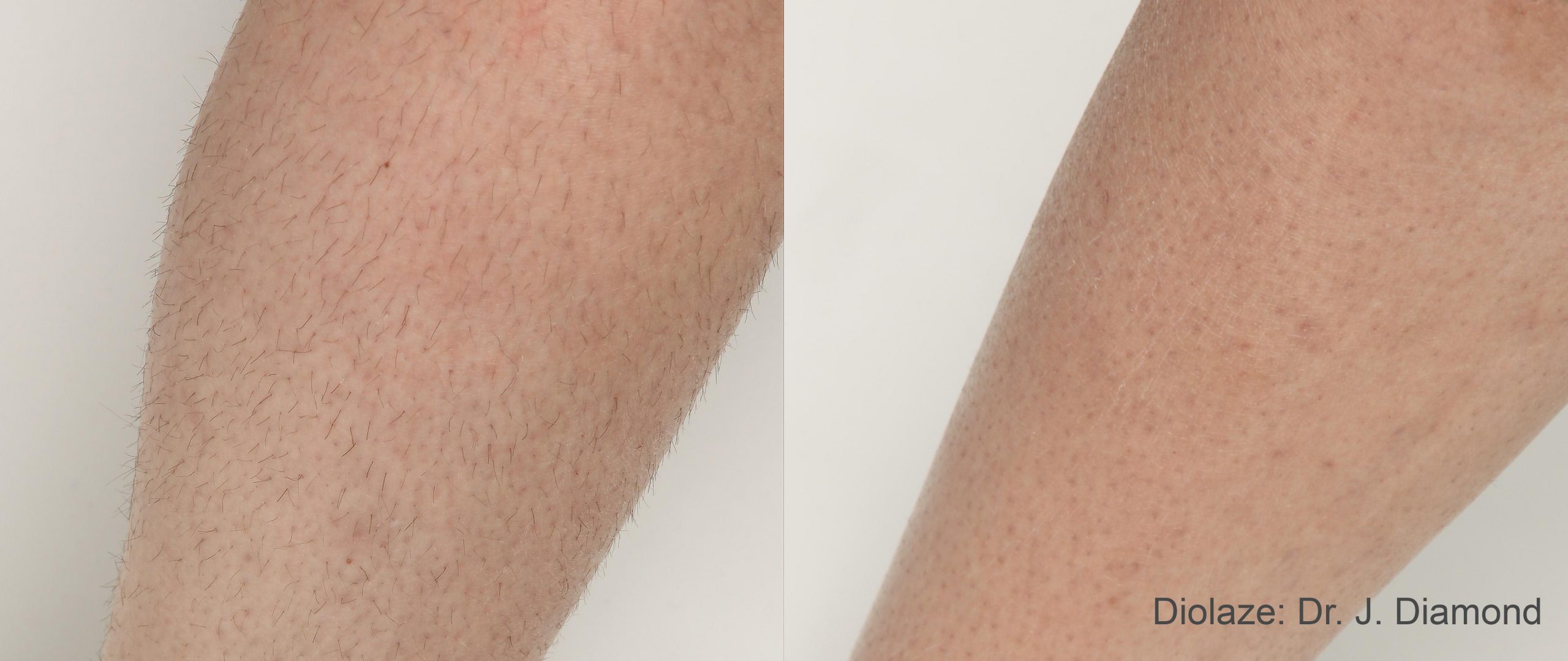 Diolaze laser hair removal