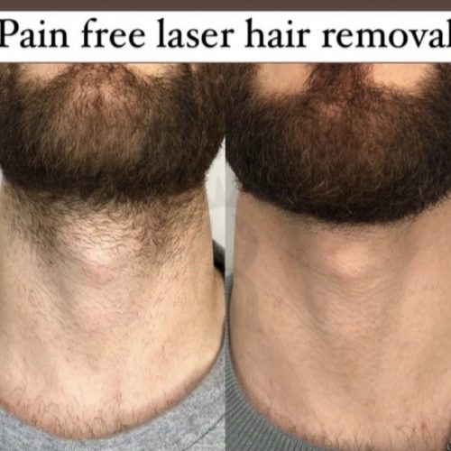 Laser hair removal.1